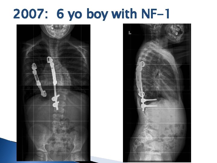 2007: 6 yo boy with NF-1 