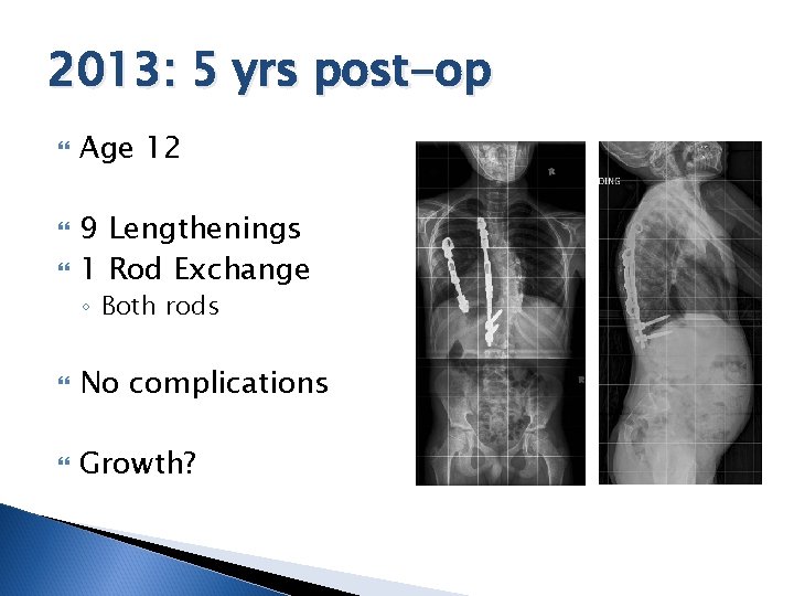 2013: 5 yrs post-op Age 12 9 Lengthenings 1 Rod Exchange ◦ Both rods