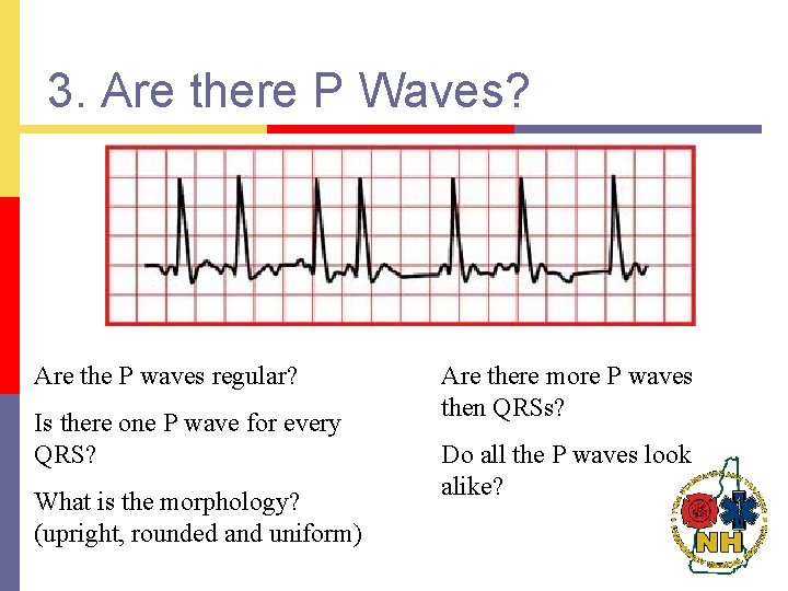 3. Are there P Waves? Are the P waves regular? Is there one P