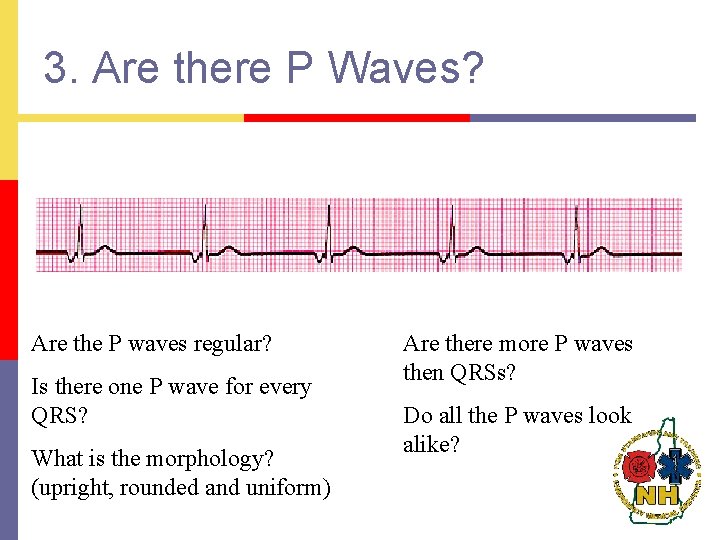 3. Are there P Waves? Are the P waves regular? Is there one P