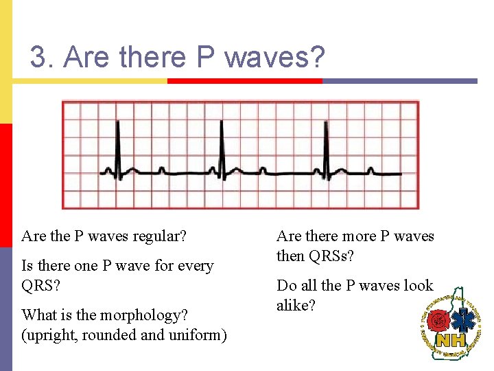 3. Are there P waves? Are the P waves regular? Is there one P