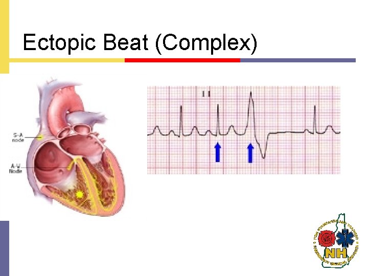 Ectopic Beat (Complex) 