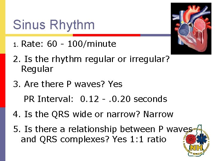 Sinus Rhythm 1. Rate: 60 - 100/minute 2. Is the rhythm regular or irregular?