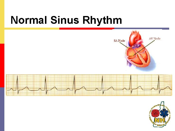 Normal Sinus Rhythm 