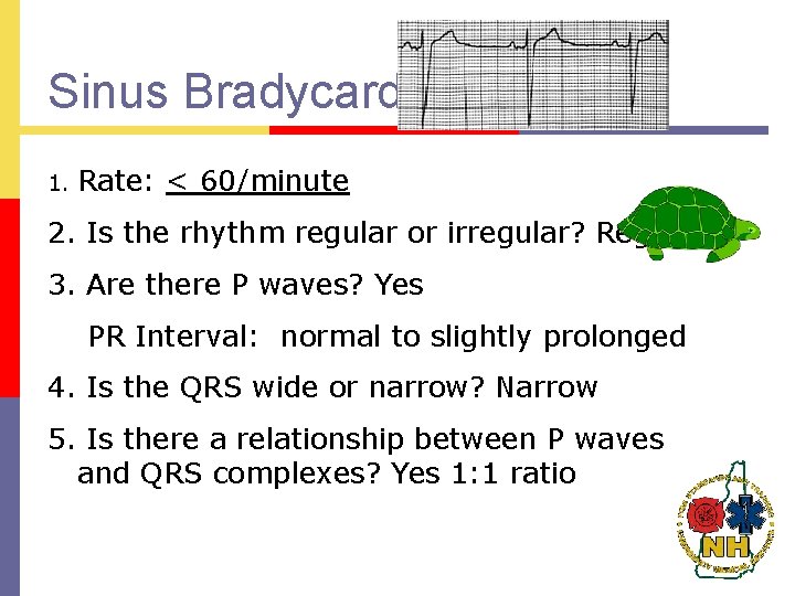 Sinus Bradycardia 1. Rate: < 60/minute 2. Is the rhythm regular or irregular? Regular
