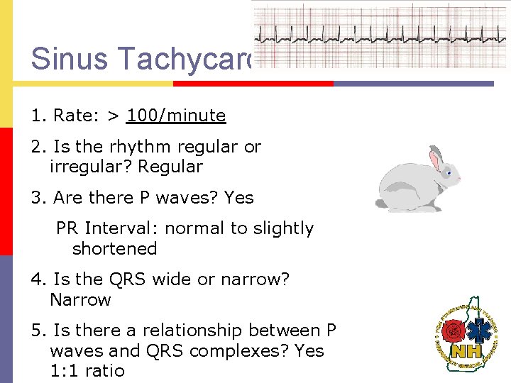 Sinus Tachycardia 1. Rate: > 100/minute 2. Is the rhythm regular or irregular? Regular