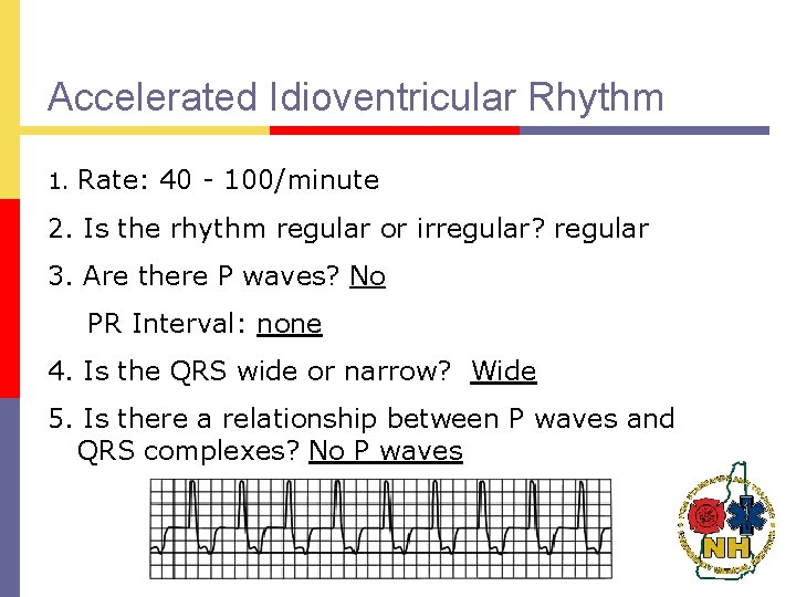 Accelerated Idioventricular Rhythm 1. Rate: 40 - 100/minute 2. Is the rhythm regular or