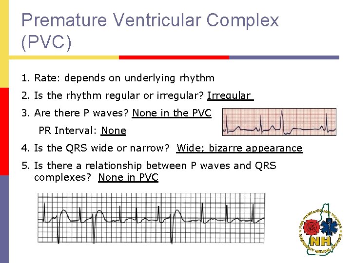 Premature Ventricular Complex (PVC) 1. Rate: depends on underlying rhythm 2. Is the rhythm