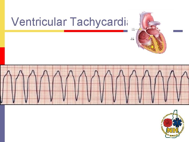 Ventricular Tachycardia 