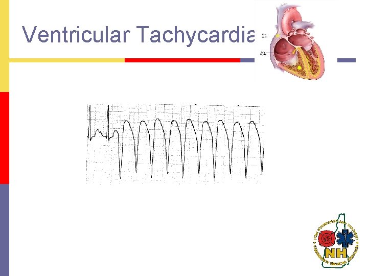 Ventricular Tachycardia 