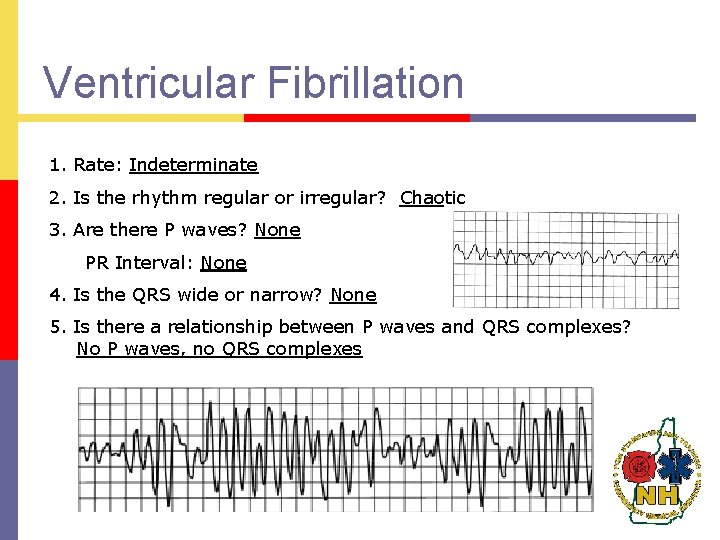 Ventricular Fibrillation 1. Rate: Indeterminate 2. Is the rhythm regular or irregular? Chaotic 3.