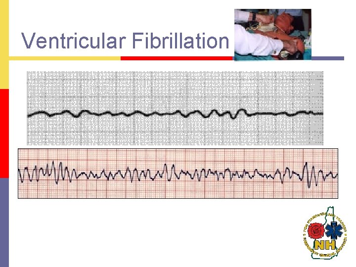 Ventricular Fibrillation 