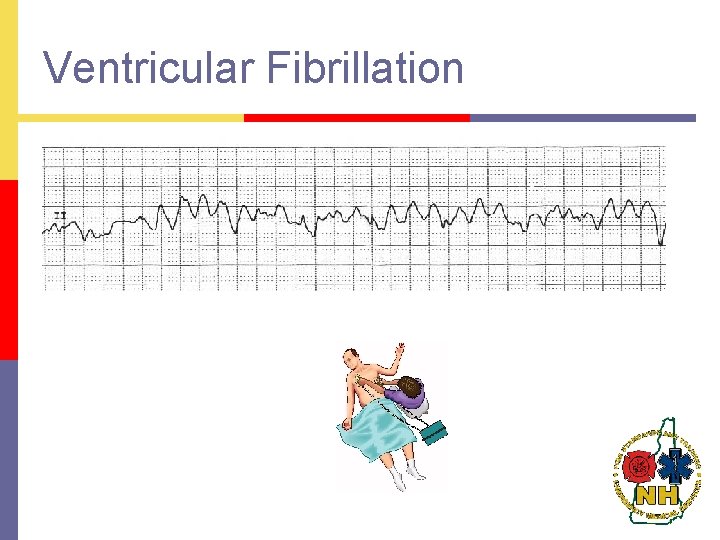 Ventricular Fibrillation 