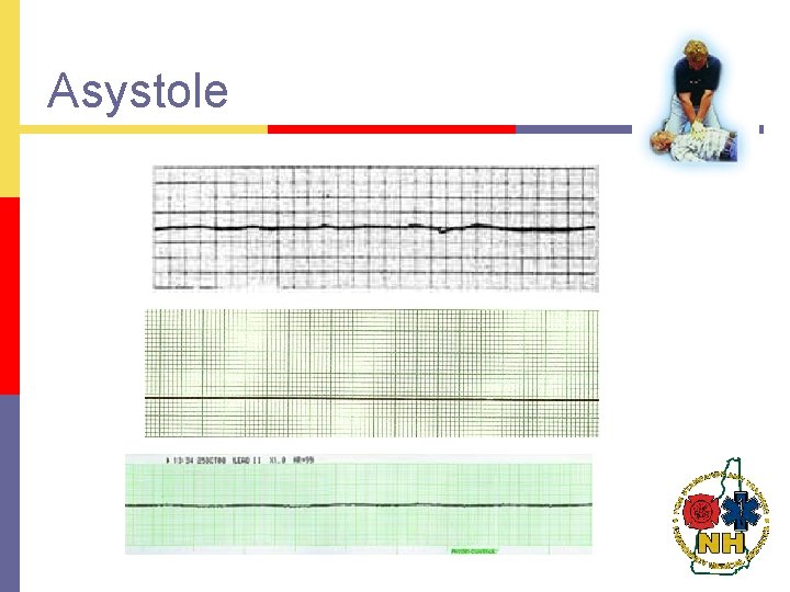 Asystole 