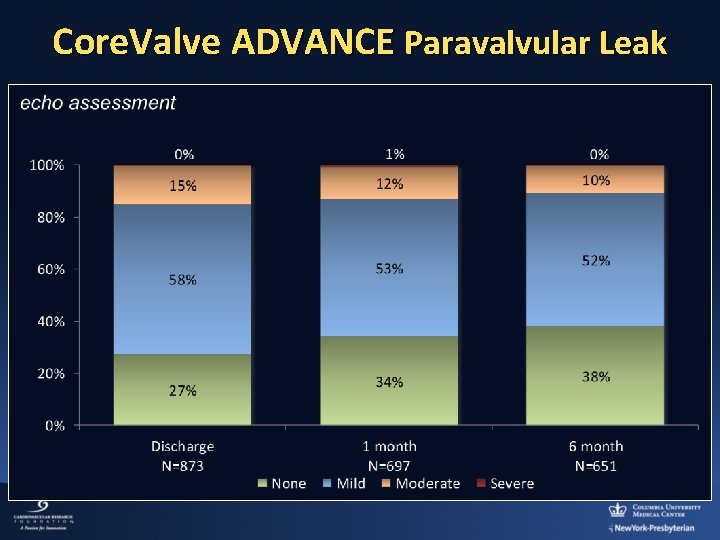 Core. Valve ADVANCE Paravalvular Leak 