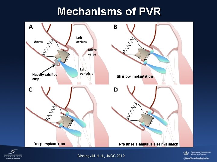 Mechanisms of PVR Shallow implantation Deep implantation Prosthesis-annulus size mismatch Sinning JM et al.