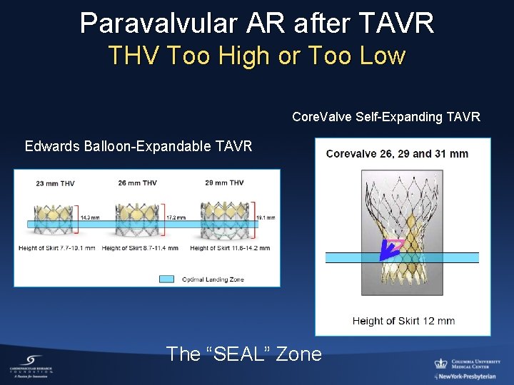 Paravalvular AR after TAVR THV Too High or Too Low Core. Valve Self-Expanding TAVR
