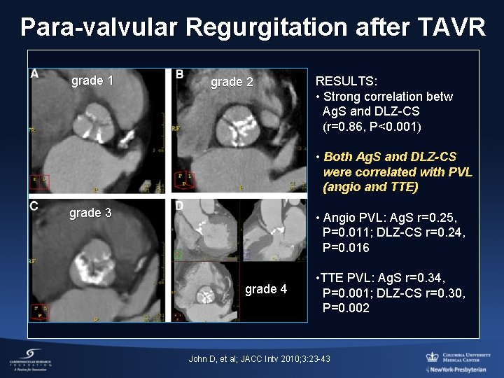 Para-valvular Regurgitation after TAVR grade 1 grade 2 RESULTS: • Strong correlation betw Ag.