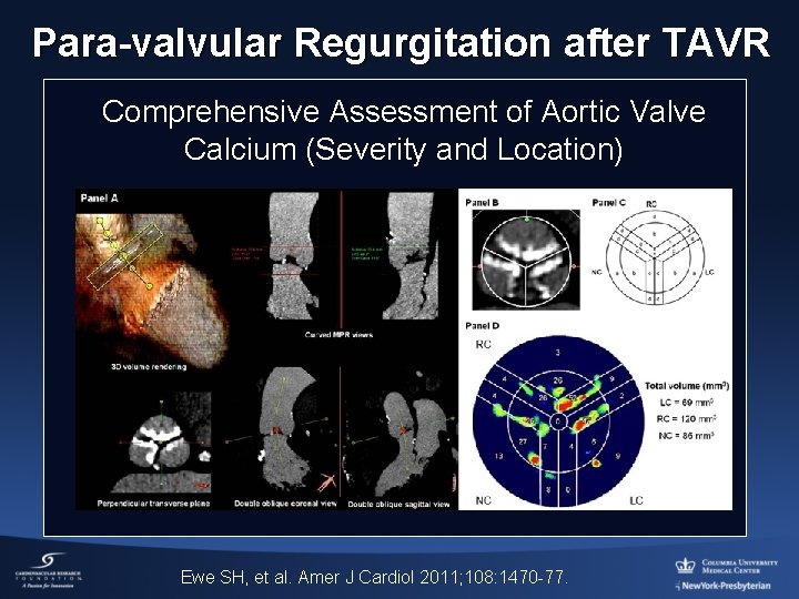 Para-valvular Regurgitation after TAVR Comprehensive Assessment of Aortic Valve Calcium (Severity and Location) Ewe