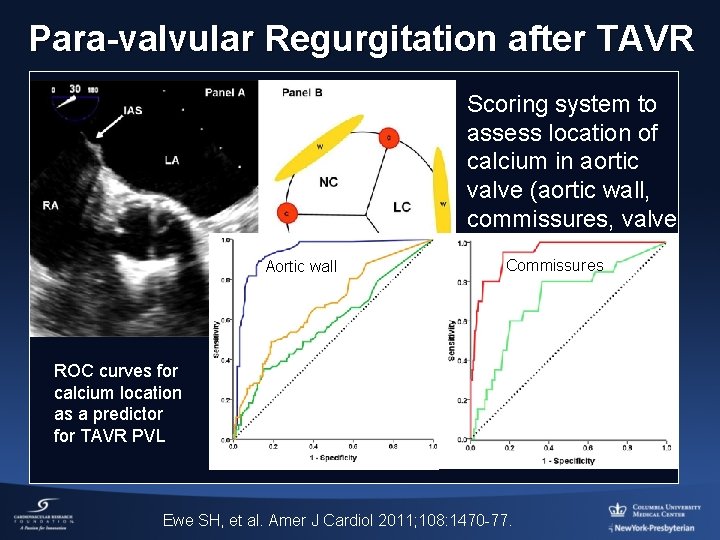 Para-valvular Regurgitation after TAVR Aortic wall Scoring system to assess location of calcium in