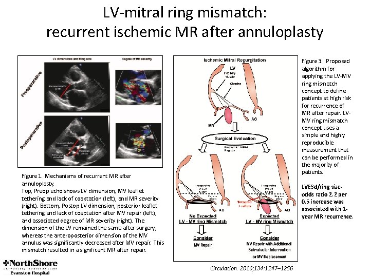 LV-mitral ring mismatch: recurrent ischemic MR after annuloplasty Figure 3. Proposed algorithm for applying