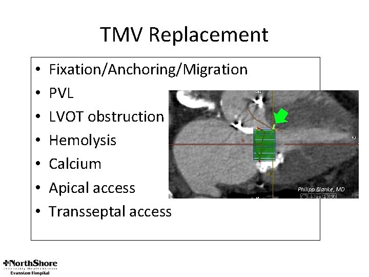 TMV Replacement • • Fixation/Anchoring/Migration PVL LVOT obstruction Hemolysis Calcium Apical access Transseptal access