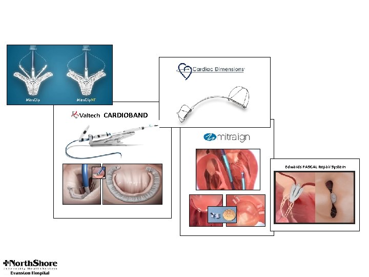 CARDIOBAND Edwards PASCAL Repair System 