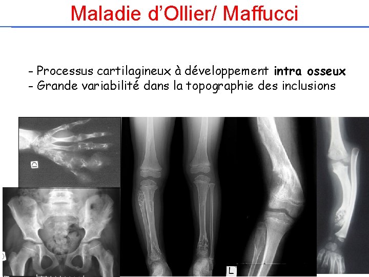 Maladie d’Ollier/ Maffucci - Processus cartilagineux à développement intra osseux - Grande variabilité dans