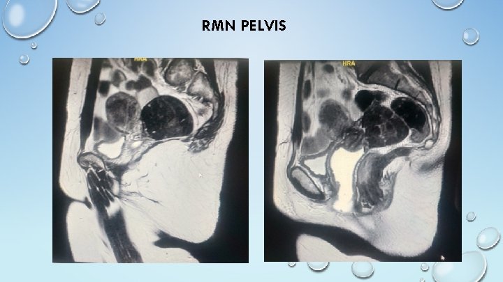 RMN PELVIS 4 