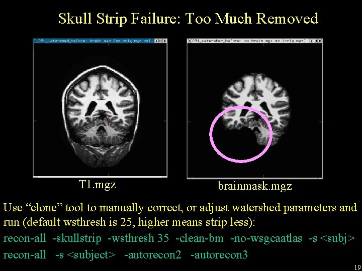 Skull Strip Failure: Too Much Removed T 1. mgz brainmask. mgz Use “clone” tool