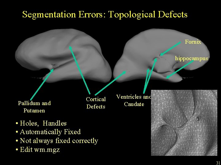 Segmentation Errors: Topological Defects Fornix hippocampus Pallidum and Putamen Cortical Defects Ventricles and Caudate