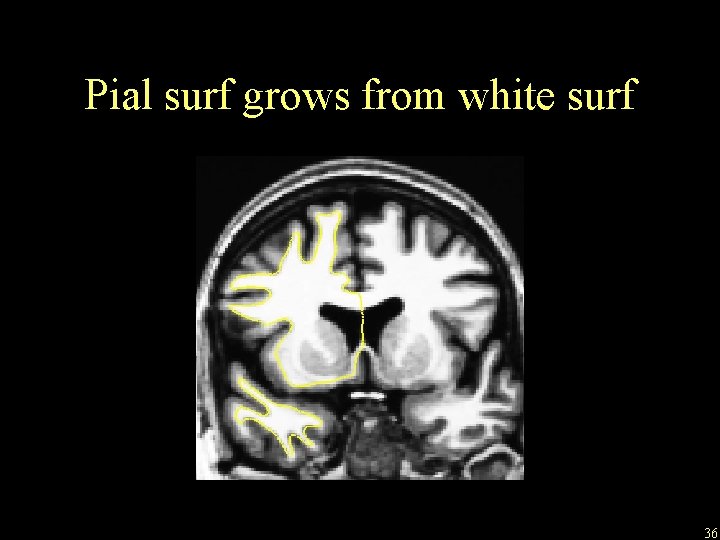 Pial surf grows from white surf 36 