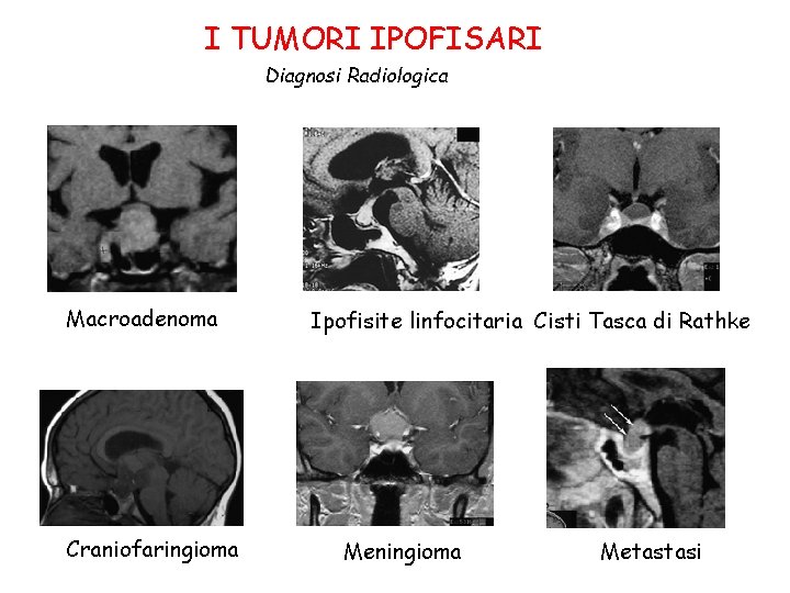I TUMORI IPOFISARI Diagnosi Radiologica Macroadenoma Craniofaringioma Ipofisite linfocitaria Cisti Tasca di Rathke Meningioma