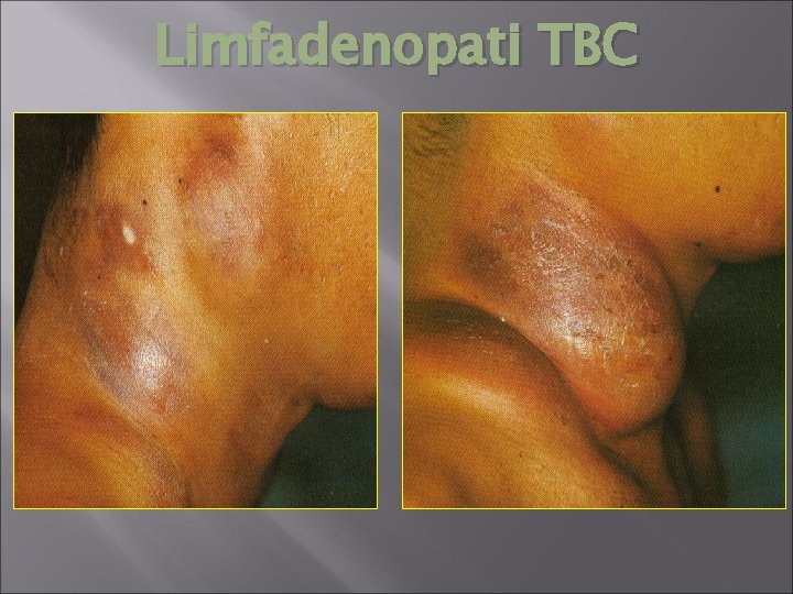 Limfadenopati TBC 