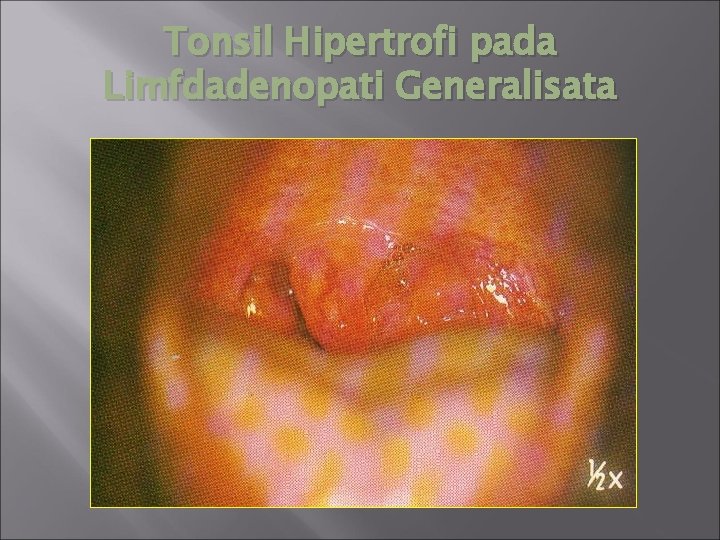 Tonsil Hipertrofi pada Limfdadenopati Generalisata 