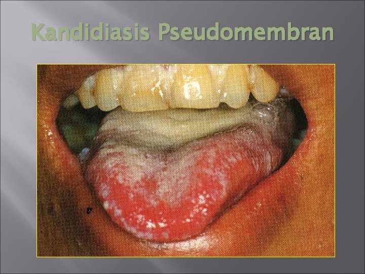 Kandidiasis Pseudomembran 
