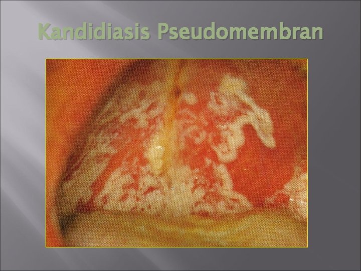 Kandidiasis Pseudomembran 