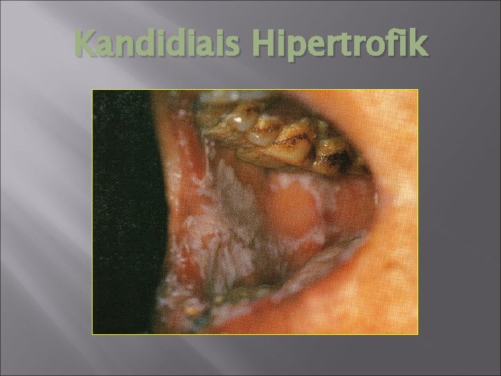 Kandidiais Hipertrofik 