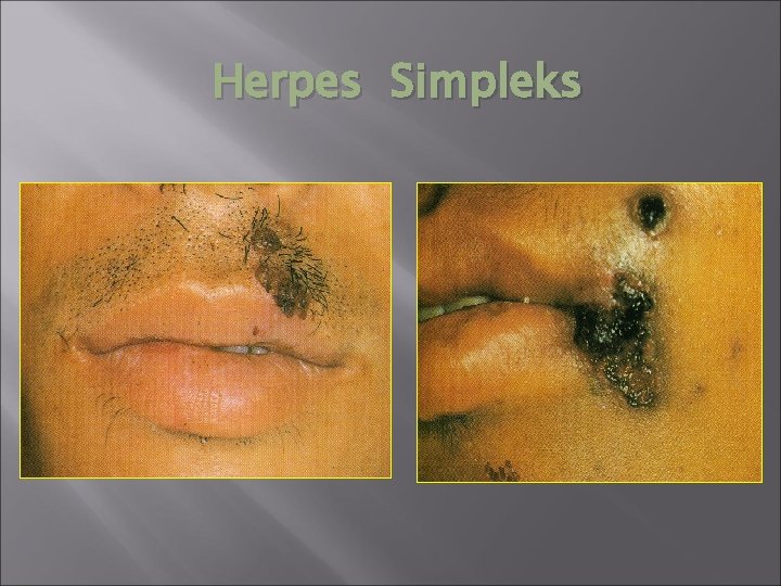 Herpes Simpleks 