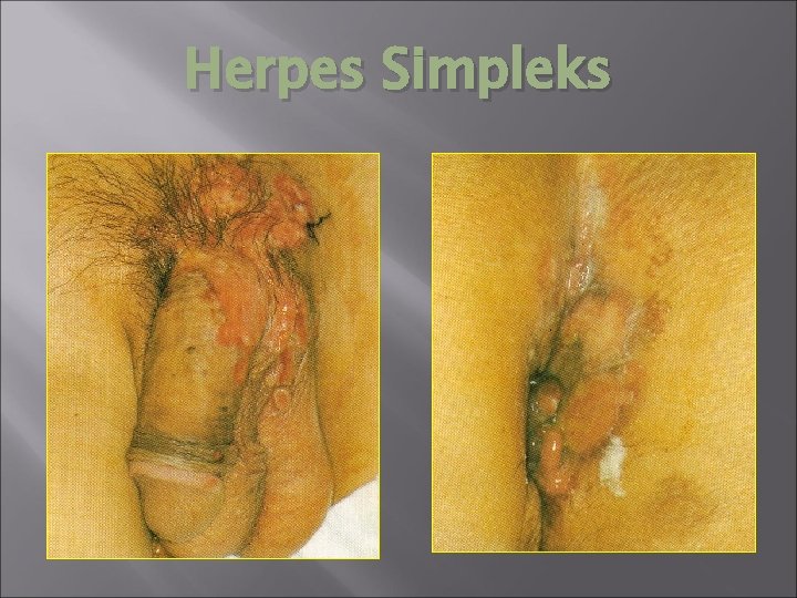Herpes Simpleks 