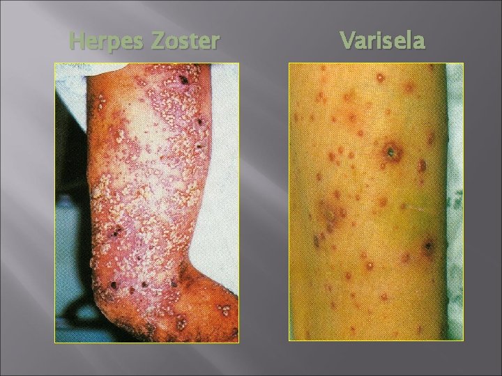 Herpes Zoster Varisela 