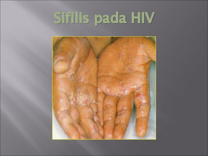 Sifilis pada HIV 