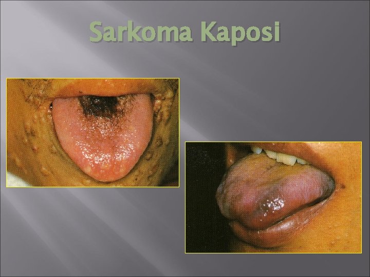 Sarkoma Kaposi 