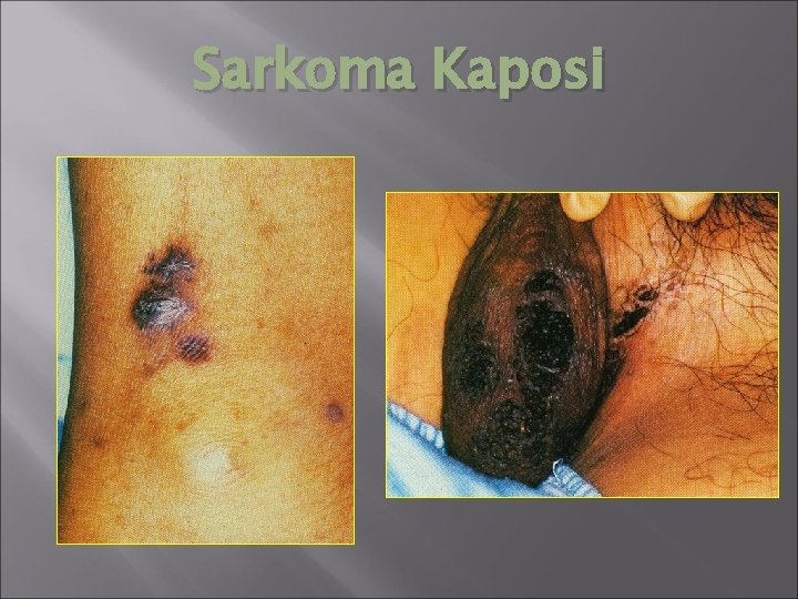 Sarkoma Kaposi 
