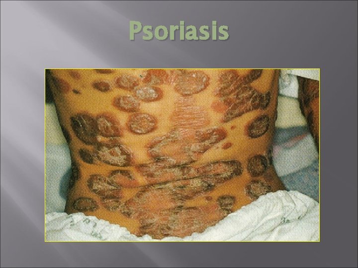 Psoriasis 