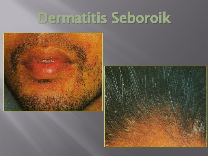 Dermatitis Seboroik 