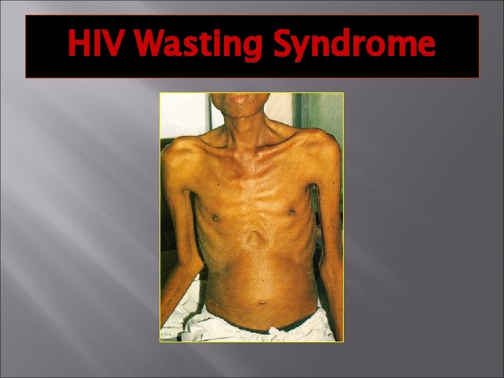 HIV Wasting Syndrome 