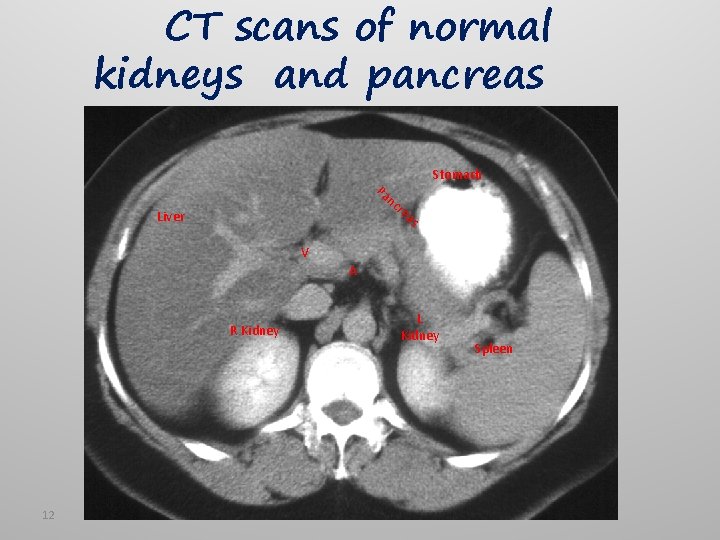 CT scans of normal kidneys and pancreas Pa nc r Stomach ea s Liver