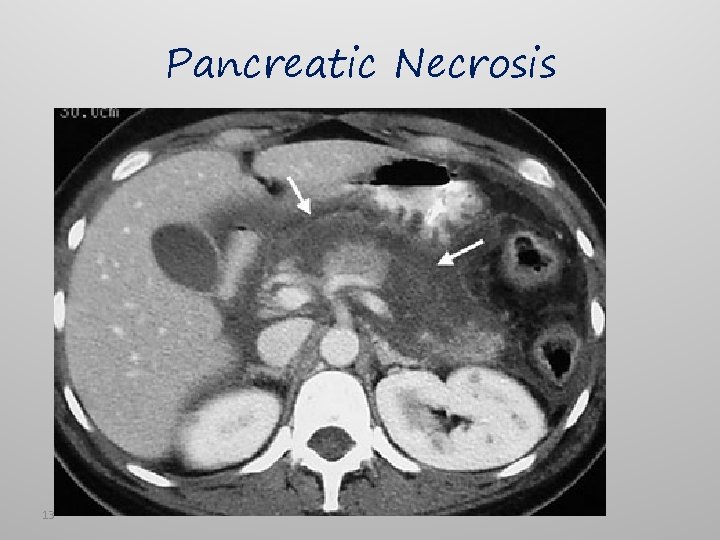 Pancreatic Necrosis 13 
