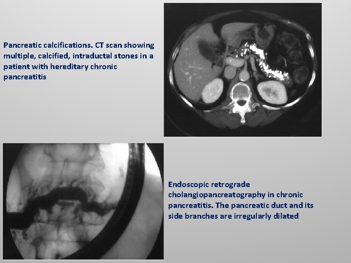 Pancreatic calcifications. CT scan showing multiple, calcified, intraductal stones in a patient with hereditary